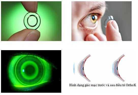 Cách giảm cận thị tại nhà và các phương pháp xóa cận hiện đại 3 Kính áp tròng Ortho-K