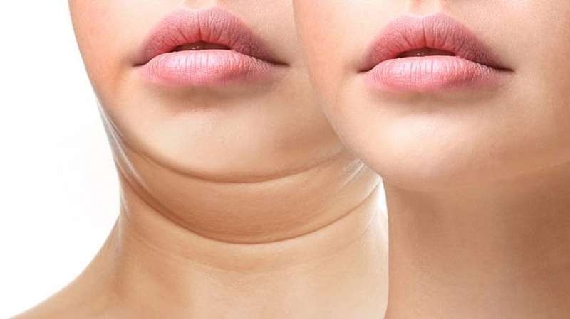 Các phương pháp hỗ trợ giảm mỡ cổ tại nhà 3 Ngấn mỡ cổ dày khiến dáng cằm bị ảnh hưởng