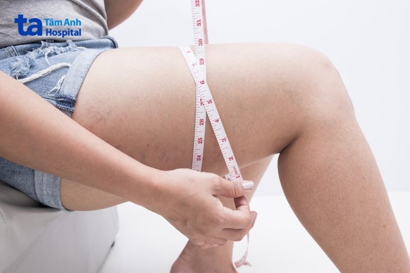Các bài tập giảm mỡ bắp đùi sau hiệu quả 2 có nhiều nguyên nhân tích mỡ đùi
